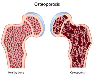 healthy bones vs osteoporosis