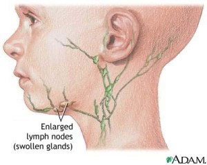 swollen lymph glands