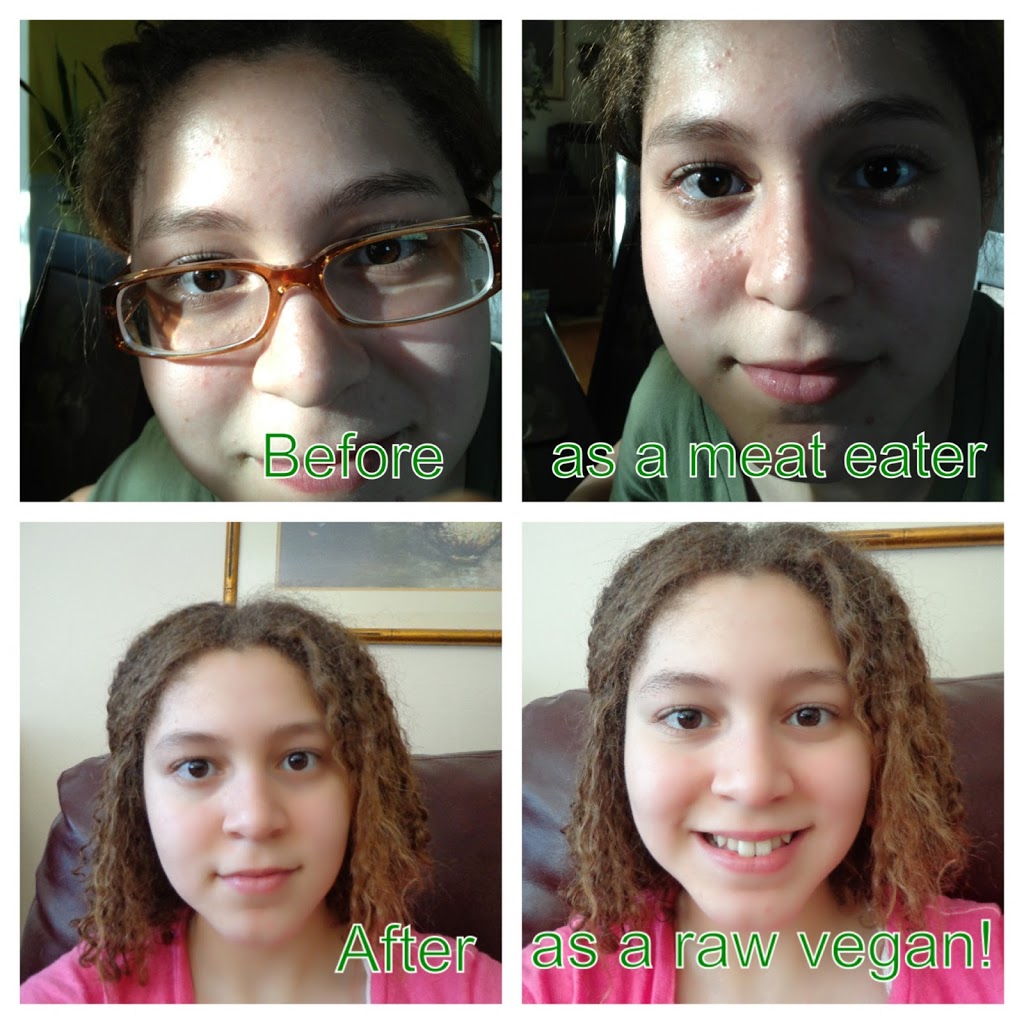 my-acne-before-amp-afters